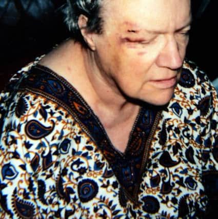An image showing the injuries sustained by Sheila Branch