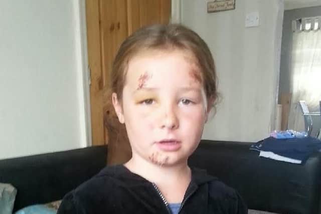 The seven-year-old suffered cuts to her chin and forehead, a chipped tooth and a number of bruises.