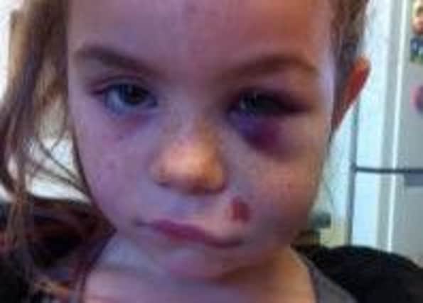 Bruising to Ebony Dowling's face after the accident.
