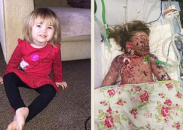 Faye Burdett before (left) and after she contracted meningitis. Picture: Meningitis Now/PA Wire

.