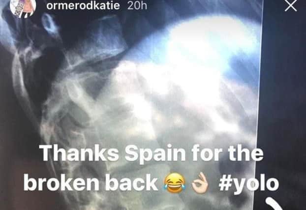 Ormerod revealed the extend of her injury on social media