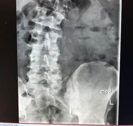 X Ray showing the bend in Tony's spine