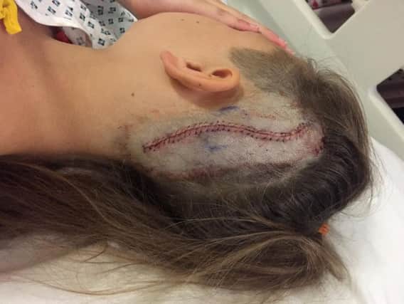 Picture of 10-year-old Lola Daley after she underwent an eight hour operation to have a brain tumour the size of a ping pong ball removed. Picture: The Sick Children's Trust/PA Wire