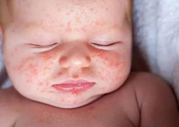 Sandpaper Rashes Warning to parents after surge in highly infectious Scarlet Fever: the ...